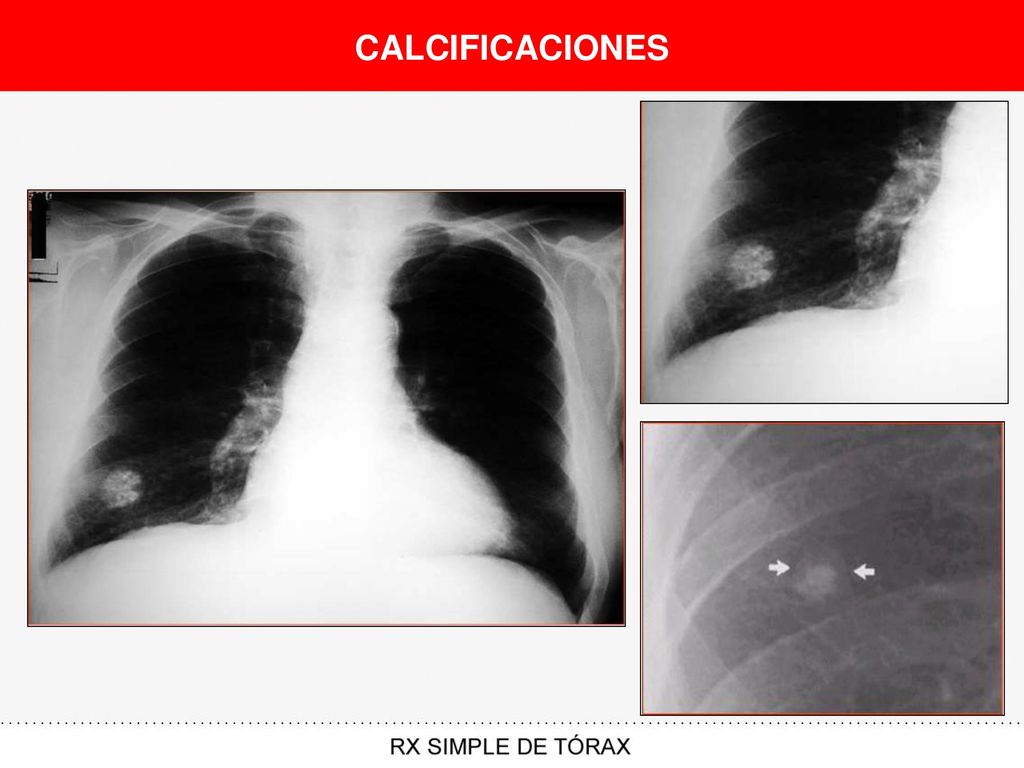 CALCIFICACIONES