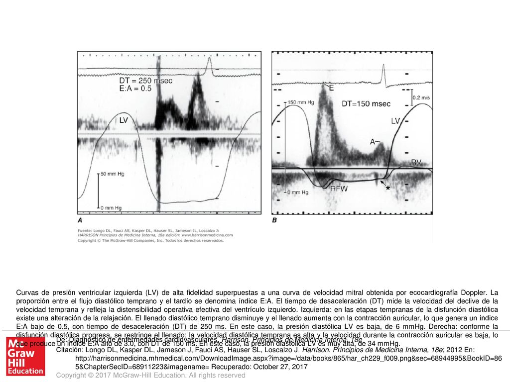 Curvas de presión ventricular izquierda (LV) de alta fidelidad superpuestas a una curva de velocidad mitral obtenida por ecocardiografía Doppler. La proporción entre el flujo diastólico temprano y el tardío se denomina índice E:A. El tiempo de desaceleración (DT) mide la velocidad del declive de la velocidad temprana y refleja la distensibilidad operativa efectiva del ventrículo izquierdo. Izquierda: en las etapas tempranas de la disfunción diastólica existe una alteración de la relajación. El llenado diastólico temprano disminuye y el llenado aumenta con la contracción auricular, lo que genera un índice E:A bajo de 0.5, con tiempo de desaceleración (DT) de 250 ms. En este caso, la presión diastólica LV es baja, de 6 mmHg. Derecha: conforme la disfunción diastólica progresa, se restringe el llenado; la velocidad diastólica temprana es alta y la velocidad durante la contracción auricular es baja, lo que produce un índice E:A alto de 3.0, con DT de 150 ms. En este caso, la presión diastólica LV es muy alta, de 34 mmHg.