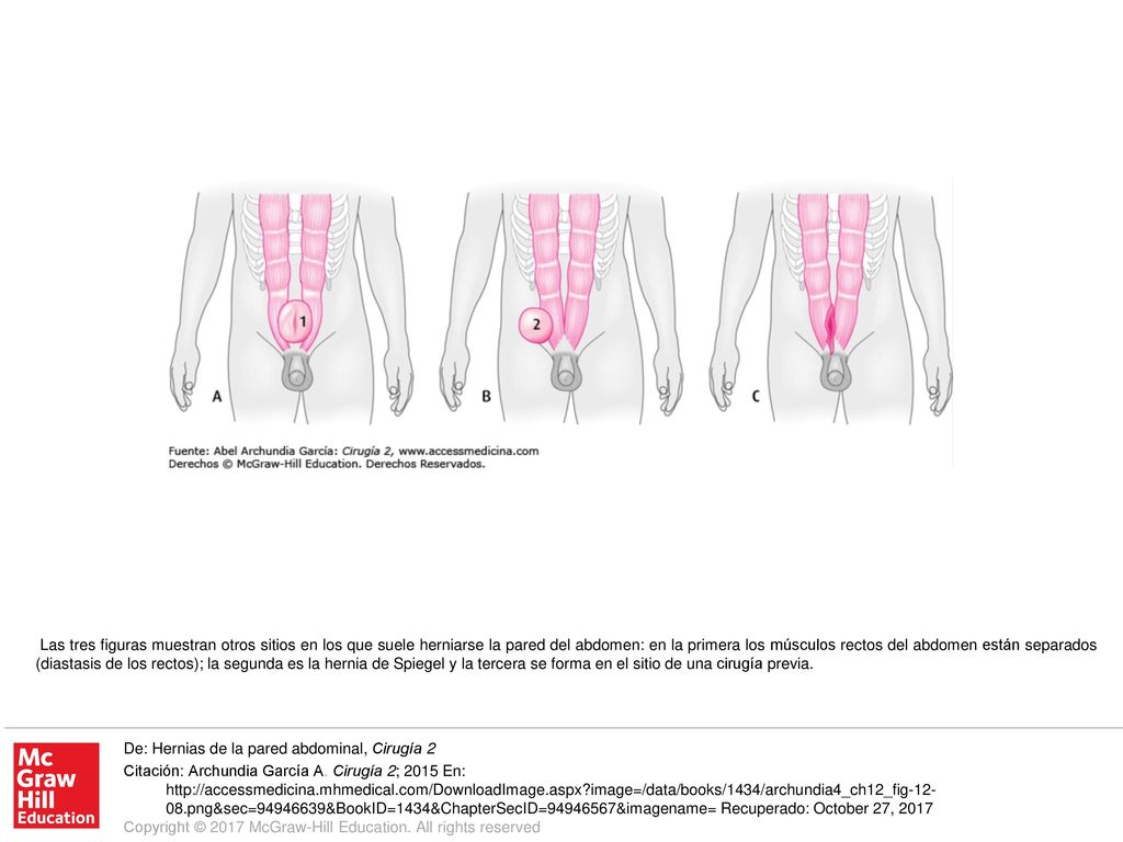 Las tres figuras muestran otros sitios en los que suele herniarse la pared del abdomen: en la primera los músculos rectos del abdomen están separados (diastasis de los rectos); la segunda es la hernia de Spiegel y la tercera se forma en el sitio de una cirugía previa.