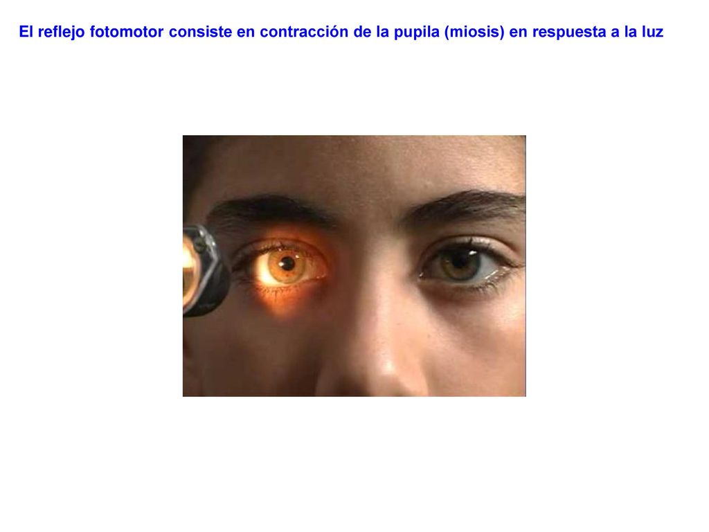 El reflejo fotomotor consiste en contracción de la pupila (miosis) en respuesta a la luz