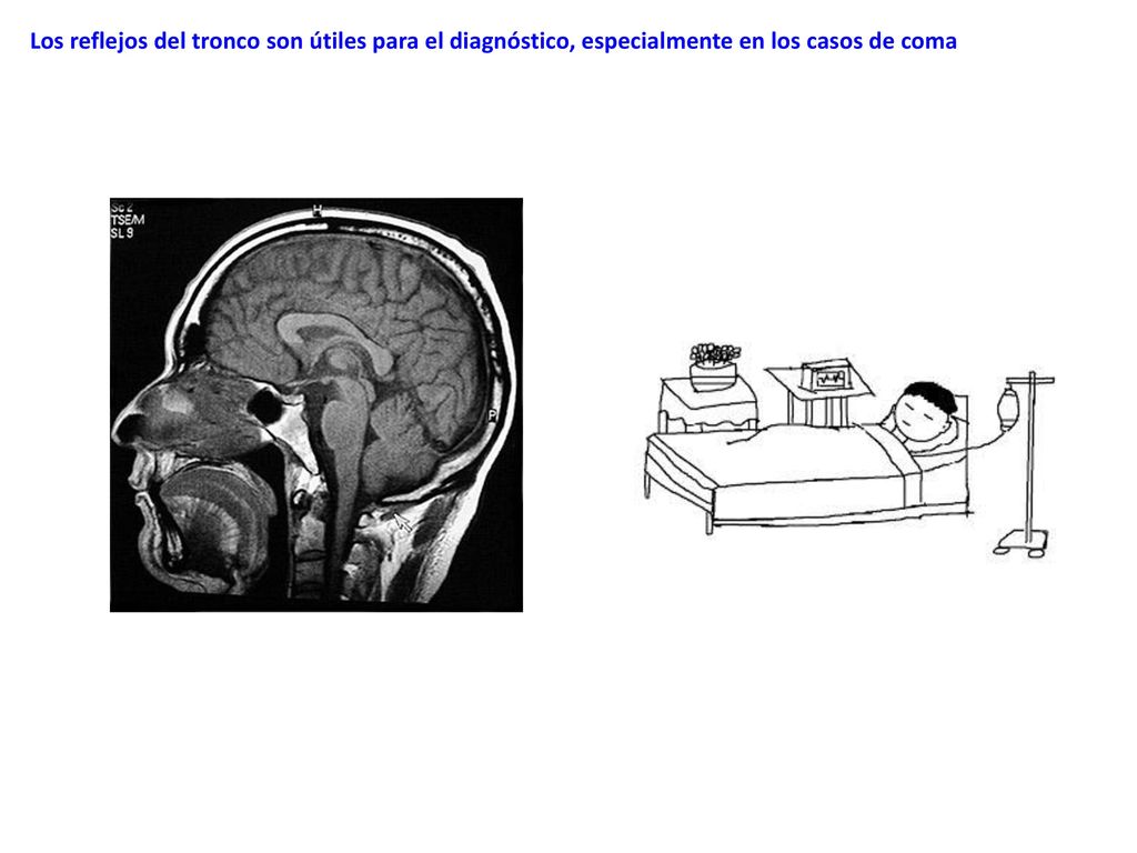 Los reflejos del tronco son útiles para el diagnóstico, especialmente en los casos de coma
