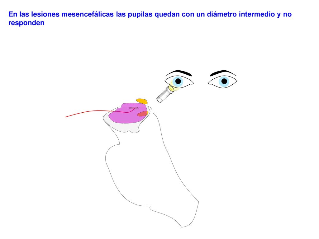 En las lesiones mesencefálicas las pupilas quedan con un diámetro intermedio y no responden