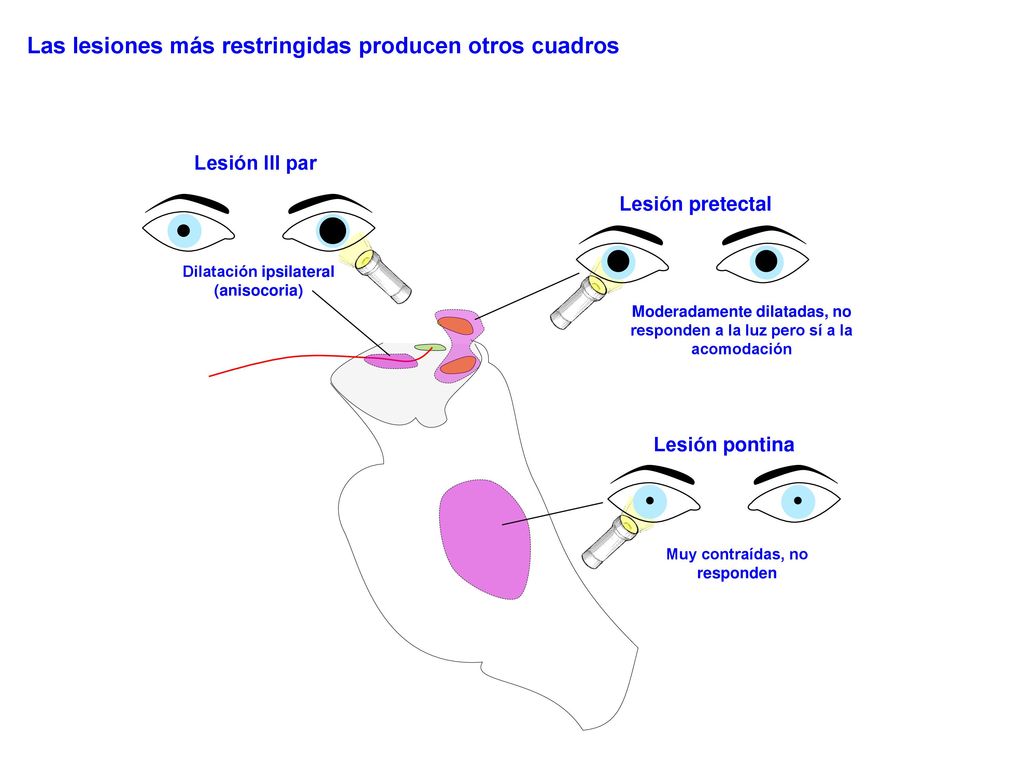 Dilatación ipsilateral (anisocoria) Muy contraídas, no responden