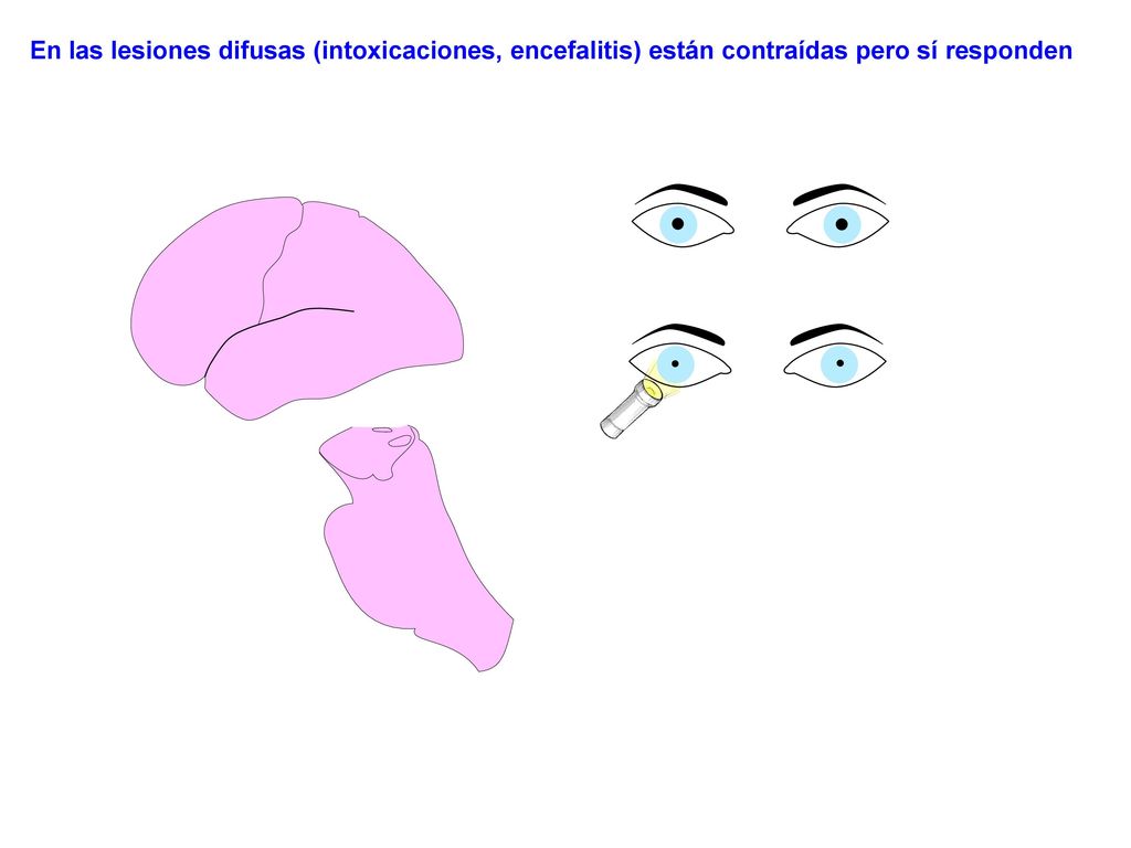 En las lesiones difusas (intoxicaciones, encefalitis) están contraídas pero sí responden
