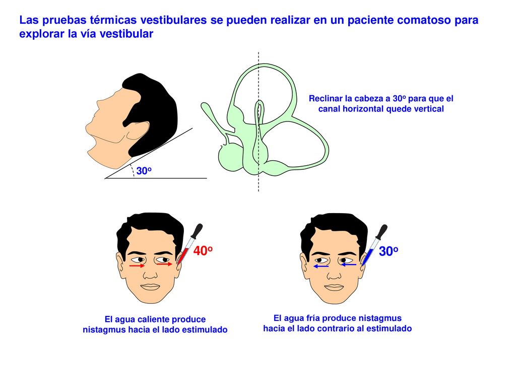 Las pruebas térmicas vestibulares se pueden realizar en un paciente comatoso para explorar la vía vestibular