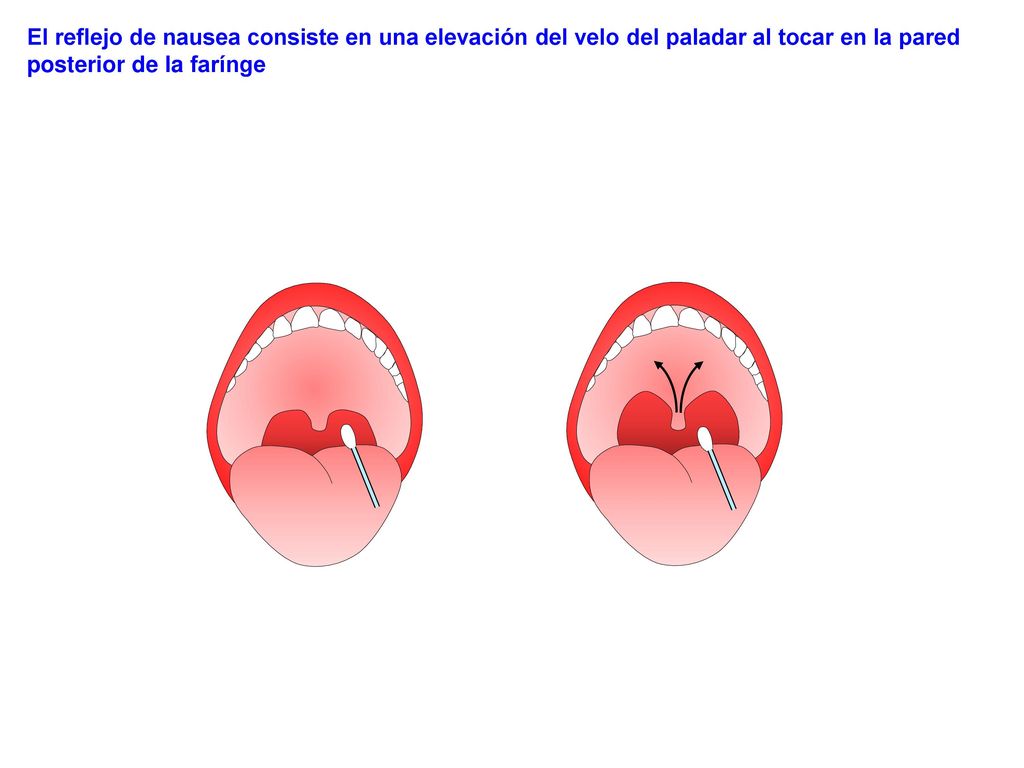 El reflejo de nausea consiste en una elevación del velo del paladar al tocar en la pared posterior de la farínge