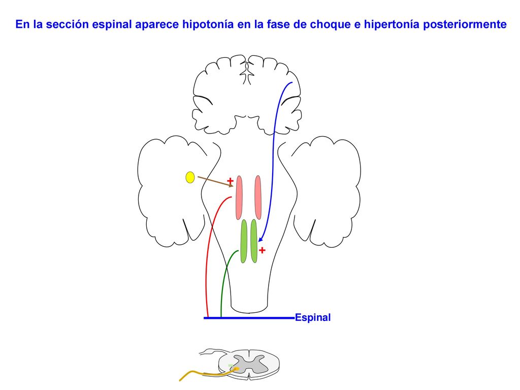 En la sección espinal aparece hipotonía en la fase de choque e hipertonía posteriormente