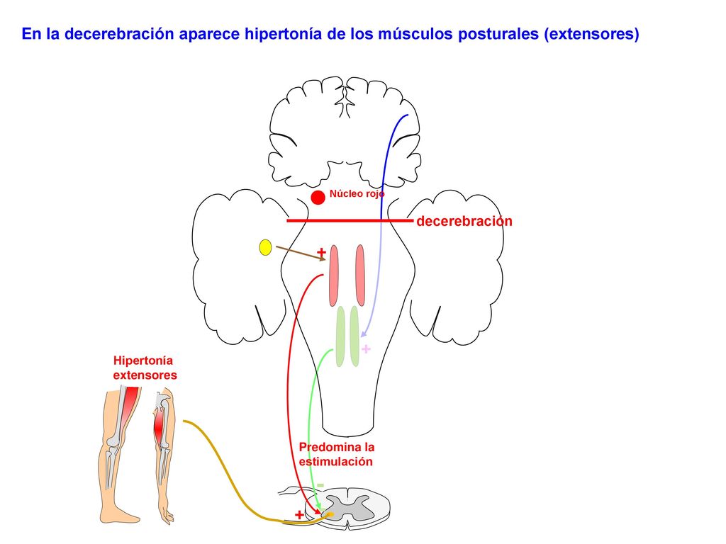 En la decerebración aparece hipertonía de los músculos posturales (extensores)