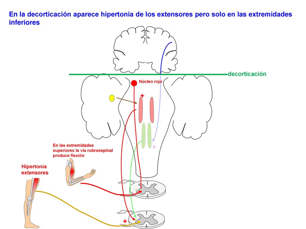 En la decorticación aparece hipertonía de los extensores pero solo en las extremidades inferiores