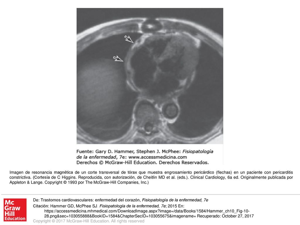 Imagen de resonancia magnética de un corte transversal de tórax que muestra engrosamiento pericárdico (flechas) en un paciente con pericarditis constrictiva. (Cortesía de C Higgins. Reproducida, con autorización, de Cheitlin MD et al. (eds.). Clinical Cardiology, 6a ed. Originalmente publicada por Appleton & Lange. Copyright © 1993 por The McGraw-Hill Companies, Inc.)