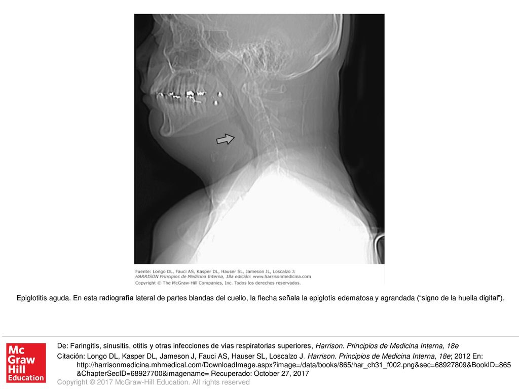 Epiglotitis aguda. En esta radiografía lateral de partes blandas del cuello, la flecha señala la epiglotis edematosa y agrandada ( signo de la huella digital ).