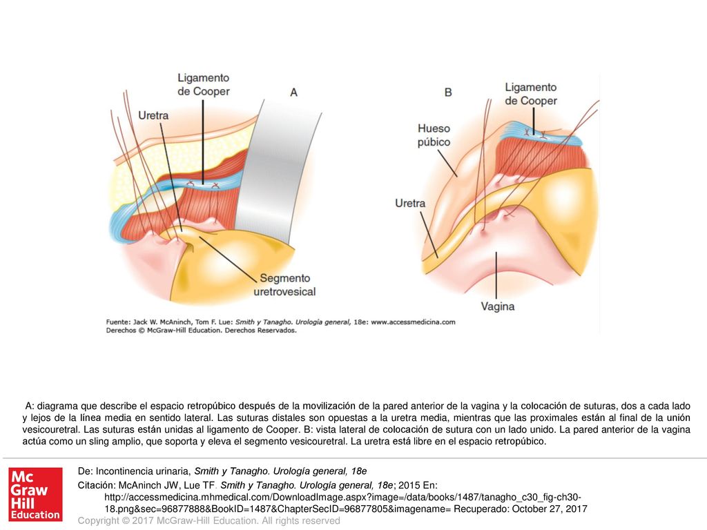 A: diagrama que describe el espacio retropúbico después de la movilización de la pared anterior de la vagina y la colocación de suturas, dos a cada lado y lejos de la línea media en sentido lateral. Las suturas distales son opuestas a la uretra media, mientras que las proximales están al final de la unión vesicouretral. Las suturas están unidas al ligamento de Cooper. B: vista lateral de colocación de sutura con un lado unido. La pared anterior de la vagina actúa como un sling amplio, que soporta y eleva el segmento vesicouretral. La uretra está libre en el espacio retropúbico.