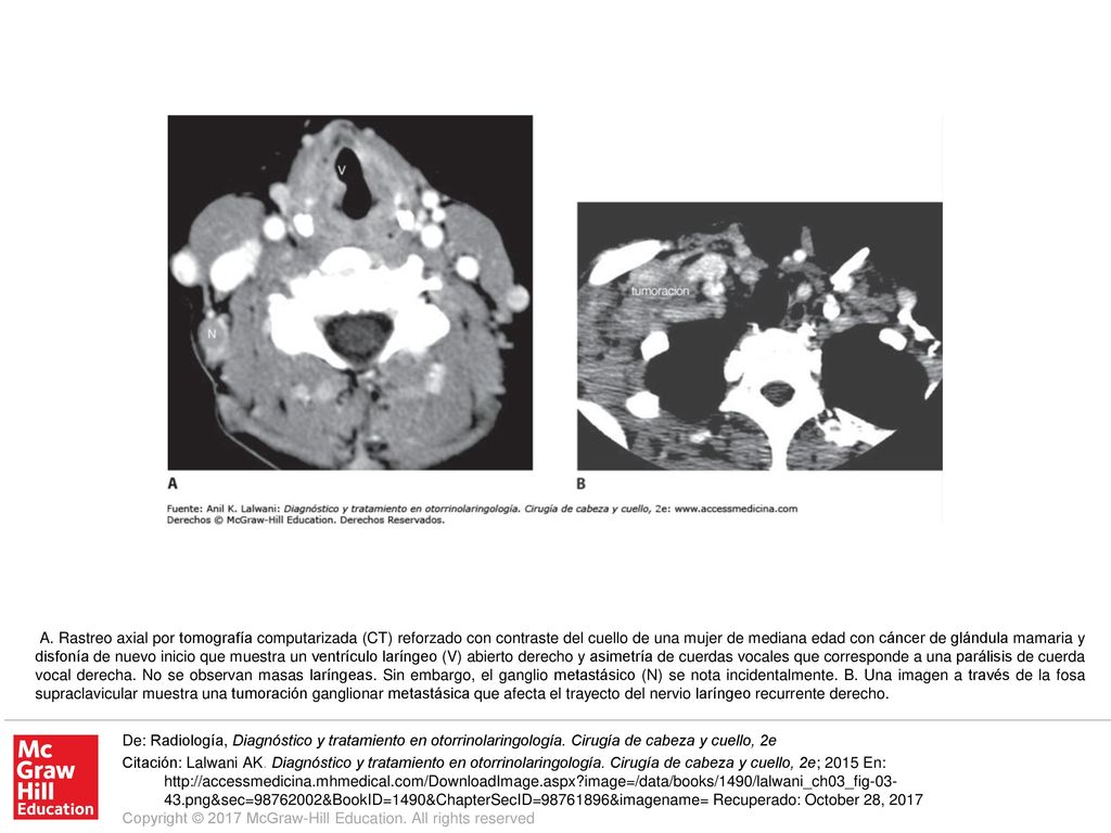 A. Rastreo axial por tomografía computarizada (CT) reforzado con contraste del cuello de una mujer de mediana edad con cáncer de glándula mamaria y disfonía de nuevo inicio que muestra un ventrículo laríngeo (V) abierto derecho y asimetría de cuerdas vocales que corresponde a una parálisis de cuerda vocal derecha. No se observan masas laríngeas. Sin embargo, el ganglio metastásico (N) se nota incidentalmente. B. Una imagen a través de la fosa supraclavicular muestra una tumoración ganglionar metastásica que afecta el trayecto del nervio laríngeo recurrente derecho.