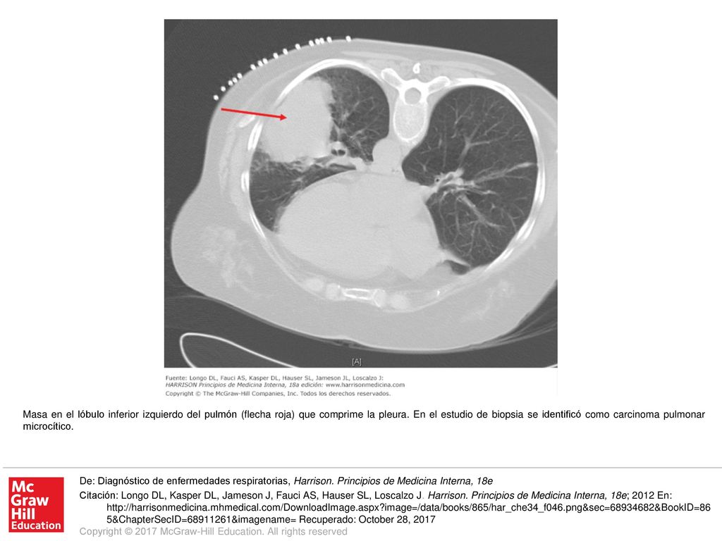 Masa en el lóbulo inferior izquierdo del pulmón (flecha roja) que comprime la pleura. En el estudio de biopsia se identificó como carcinoma pulmonar microcítico.