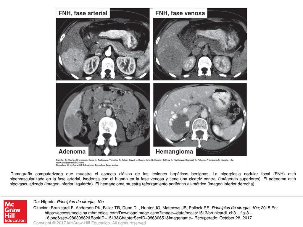 Tomografía computarizada que muestra el aspecto clásico de las lesiones hepáticas benignas. La hiperplasia nodular focal (FNH) está hipervascularizada en la fase arterial, isodensa con el hígado en la fase venosa y tiene una cicatriz central (imágenes superiores). El adenoma está hipovascularizado (imagen inferior izquierda). El hemangioma muestra reforzamiento periférico asimétrico (imagen inferior derecha).
