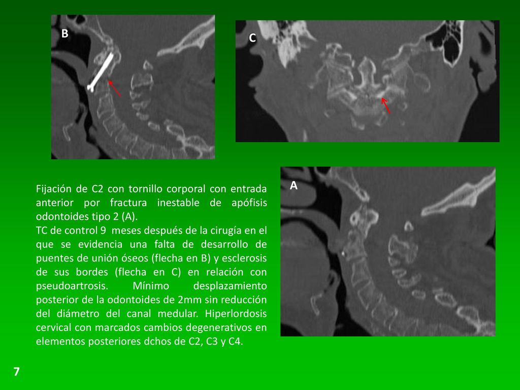 B C. A. Fijación de C2 con tornillo corporal con entrada anterior por fractura inestable de apófisis odontoides tipo 2 (A).