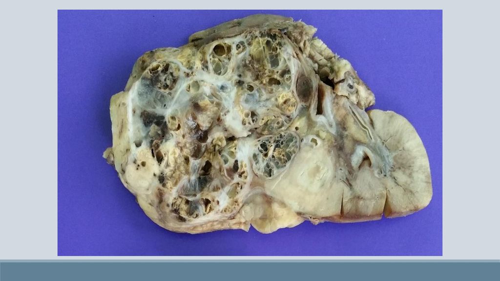The International Society of Urologic Pathology 2012 Consensus Conference on renal cancer, through working group 3, focused on the issues of staging and specimen handling of renal tumors. The conference was preceded by an online surveyof the International Society of Urologic Pathology members,