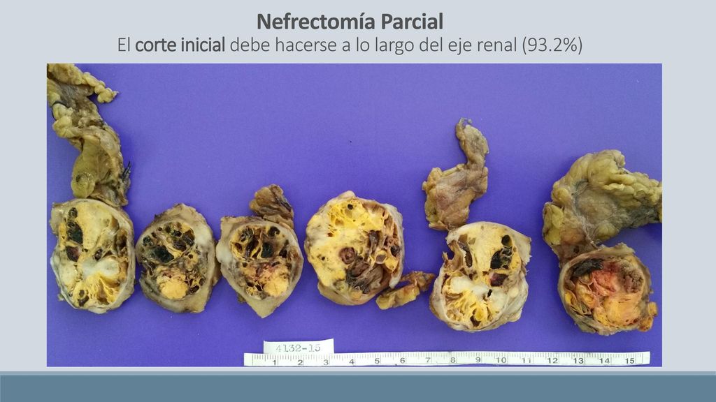 Nefrectomía Parcial El corte inicial debe hacerse a lo largo del eje renal (93.2%)