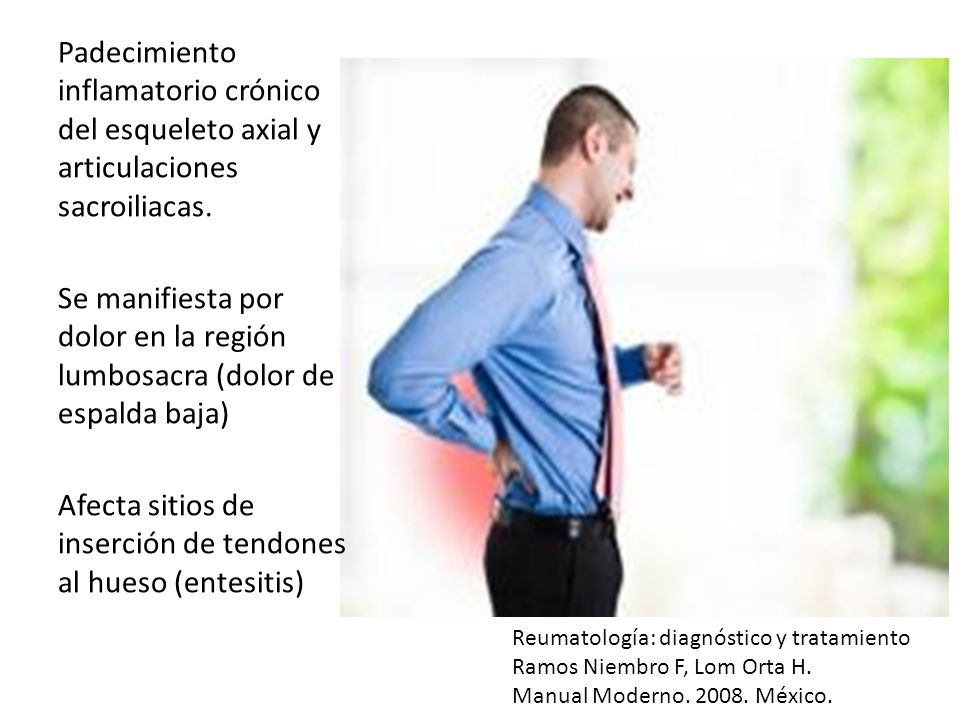 Afecta sitios de inserción de tendones al hueso (entesitis)