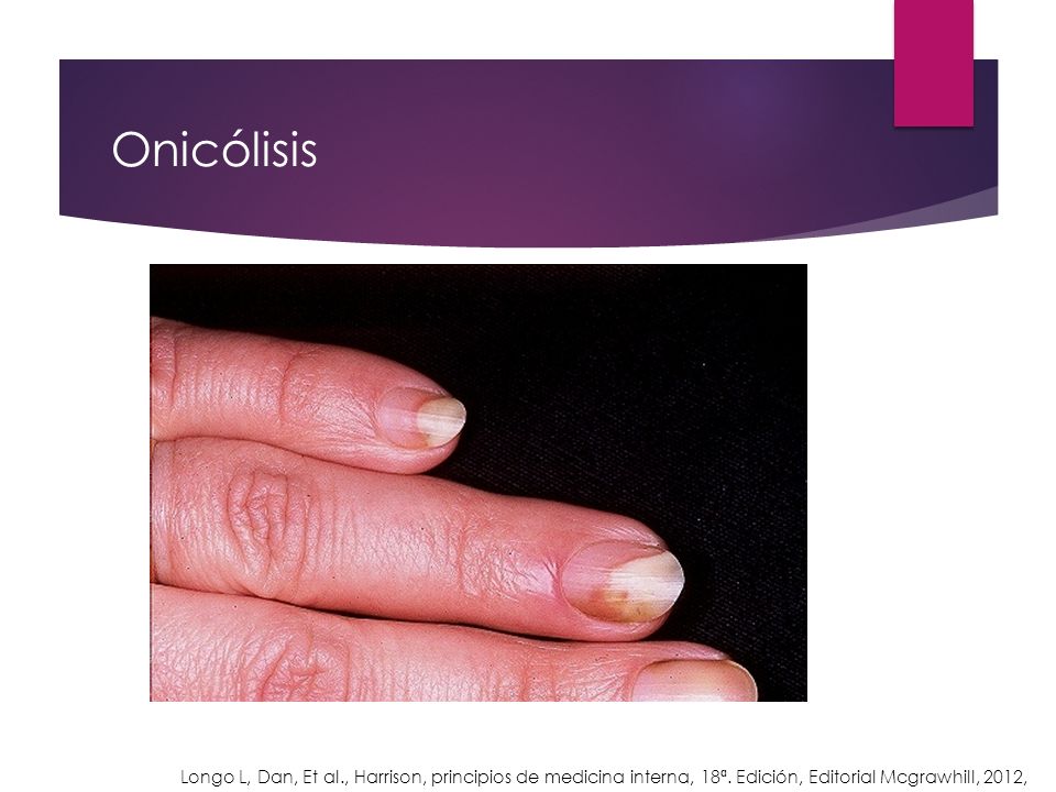 Onicólisis Longo L, Dan, Et al., Harrison, principios de medicina interna, 18ª.