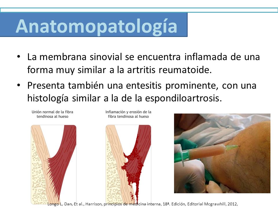 Anatomopatología La membrana sinovial se encuentra inflamada de una forma muy similar a la artritis reumatoide.