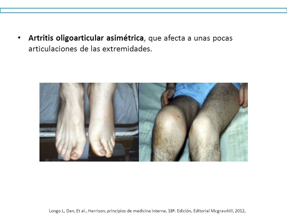 Artritis oligoarticular asimétrica, que afecta a unas pocas articulaciones de las extremidades.