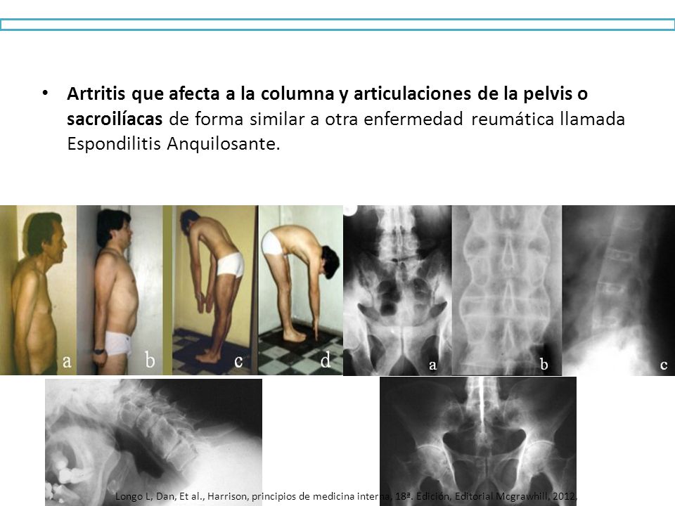 Artritis que afecta a la columna y articulaciones de la pelvis o sacroilíacas de forma similar a otra enfermedad reumática llamada Espondilitis Anquilosante.