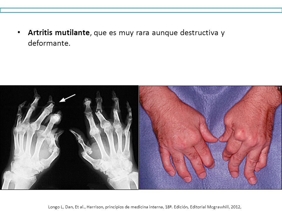 Artritis mutilante, que es muy rara aunque destructiva y deformante.