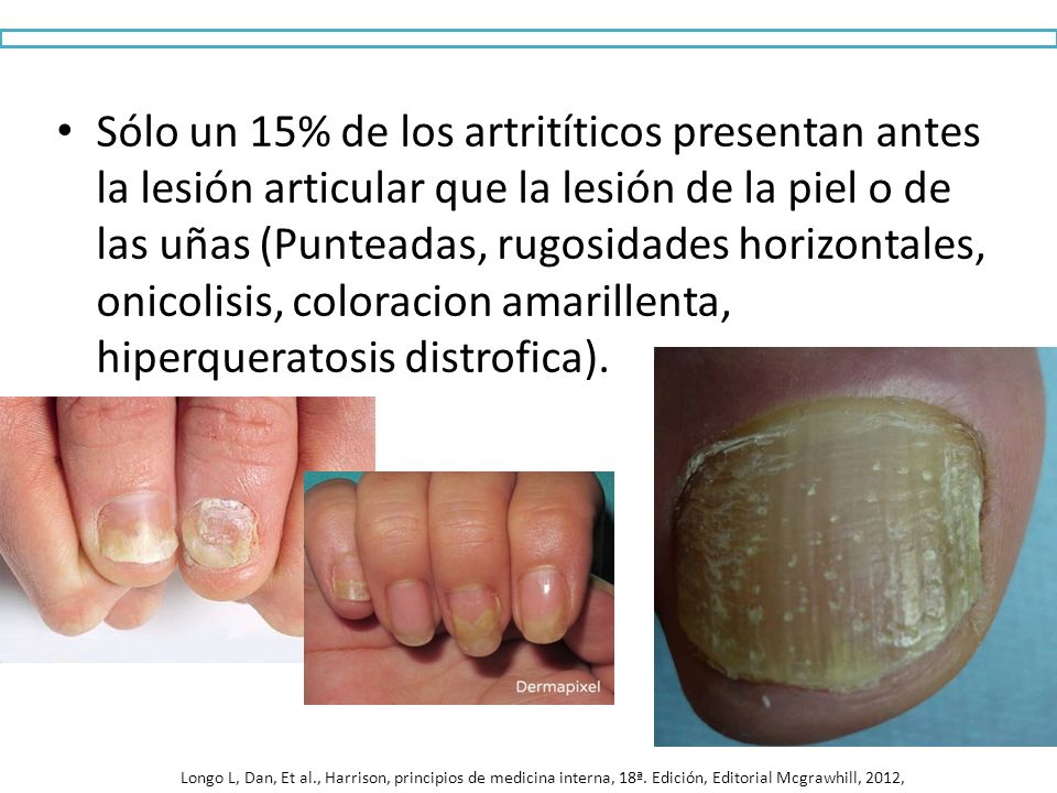 Sólo un 15% de los artritíticos presentan antes la lesión articular que la lesión de la piel o de las uñas (Punteadas, rugosidades horizontales, onicolisis, coloracion amarillenta, hiperqueratosis distrofica).