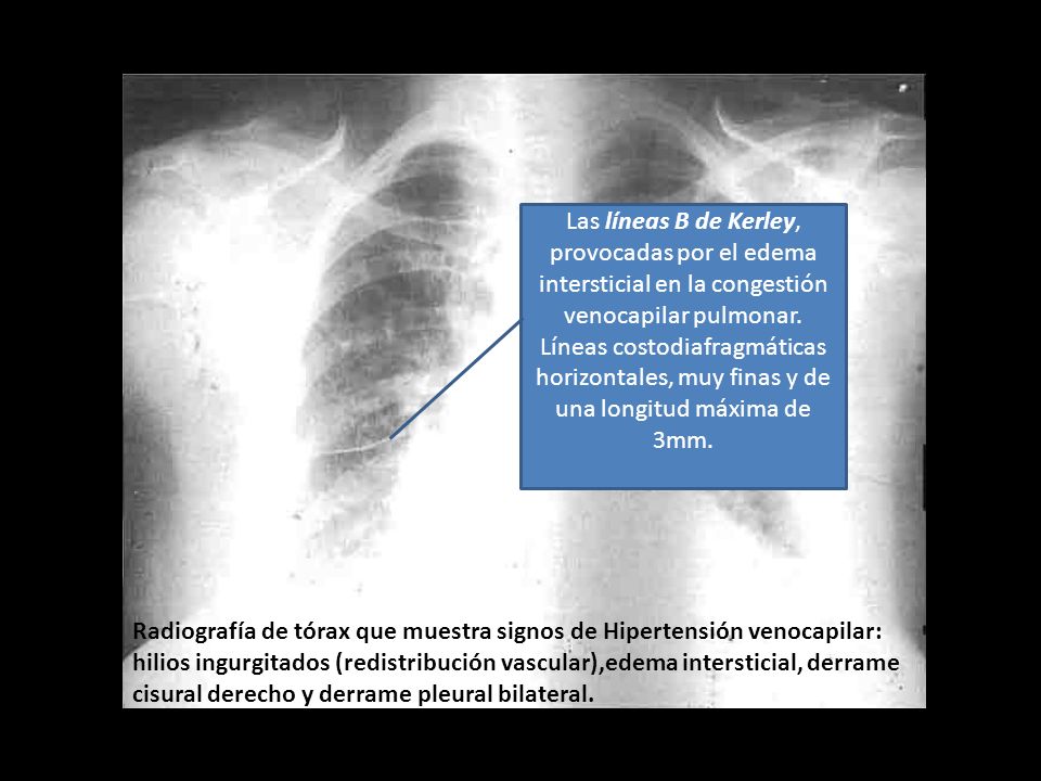 Las líneas B de Kerley, provocadas por el edema intersticial en la congestión venocapilar pulmonar. Líneas costodiafragmáticas horizontales, muy finas y de una longitud máxima de 3mm.