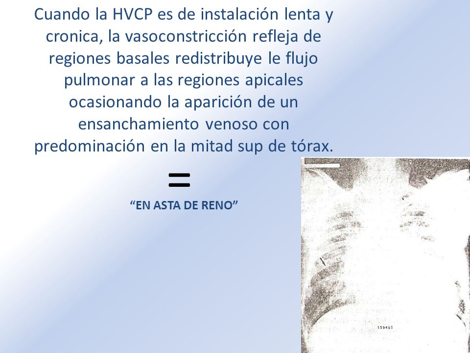 Cuando la HVCP es de instalación lenta y cronica, la vasoconstricción refleja de regiones basales redistribuye le flujo pulmonar a las regiones apicales ocasionando la aparición de un ensanchamiento venoso con predominación en la mitad sup de tórax.