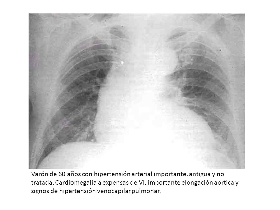 Varón de 60 años con hipertensión arterial importante, antigua y no tratada.