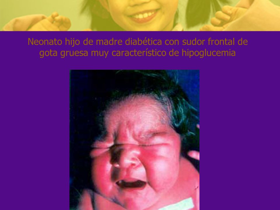 Neonato hijo de madre diabética con sudor frontal de gota gruesa muy característico de hipoglucemia