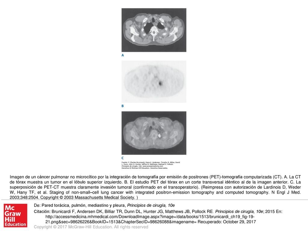 Imagen de un cáncer pulmonar no microcítico por la integración de tomografía por emisión de positrones (PET)-tomografía computarizada (CT). A. La CT de tórax muestra un tumor en el lóbulo superior izquierdo. B. El estudio PET del tórax en un corte transversal idéntico al de la imagen anterior. C. La superposición de PET-CT muestra claramente invasión tumoral (confirmado en el transoperatorio). (Reimpresa con autorización de Lardinois D, Weder W, Hany TF, et al. Staging of non-small–cell lung cancer with integrated positron-emission tomography and computed tomography. N Engl J Med. 2003;348:2504. Copyright © 2003 Massachusetts Medical Society. )