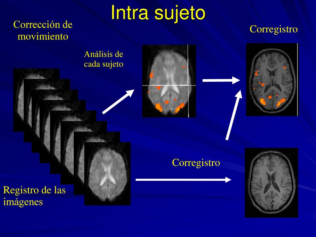 Intra sujeto Corrección de Corregistro movimiento Corregistro