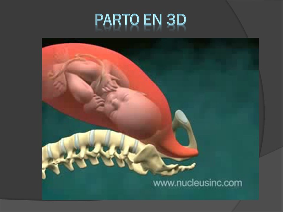 PARTO EN 3D