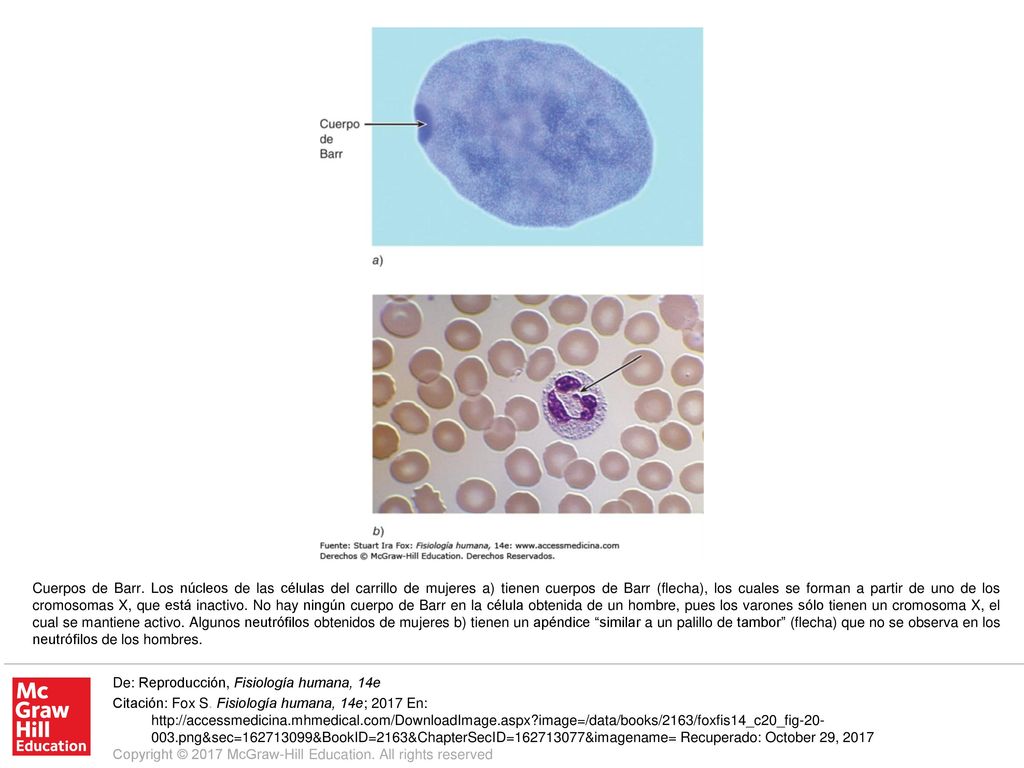Cuerpos de Barr. Los núcleos de las células del carrillo de mujeres a) tienen cuerpos de Barr (flecha), los cuales se forman a partir de uno de los cromosomas X, que está inactivo. No hay ningún cuerpo de Barr en la célula obtenida de un hombre, pues los varones sólo tienen un cromosoma X, el cual se mantiene activo. Algunos neutrófilos obtenidos de mujeres b) tienen un apéndice similar a un palillo de tambor (flecha) que no se observa en los neutrófilos de los hombres.
