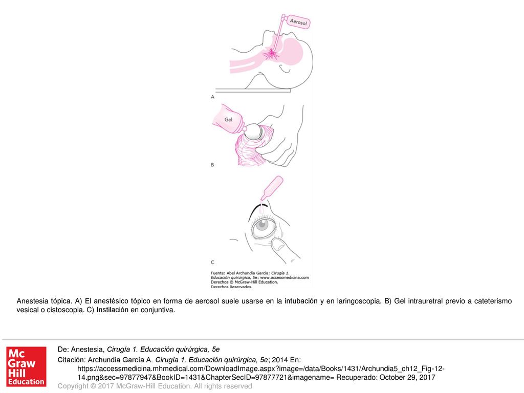 Anestesia tópica. A) El anestésico tópico en forma de aerosol suele usarse en la intubación y en laringoscopia. B) Gel intrauretral previo a cateterismo vesical o cistoscopia. C) Instilación en conjuntiva.