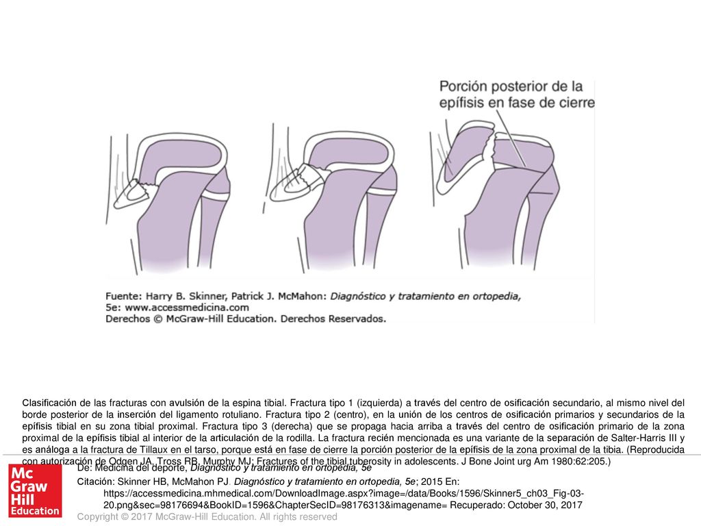 Clasificación de las fracturas con avulsión de la espina tibial
