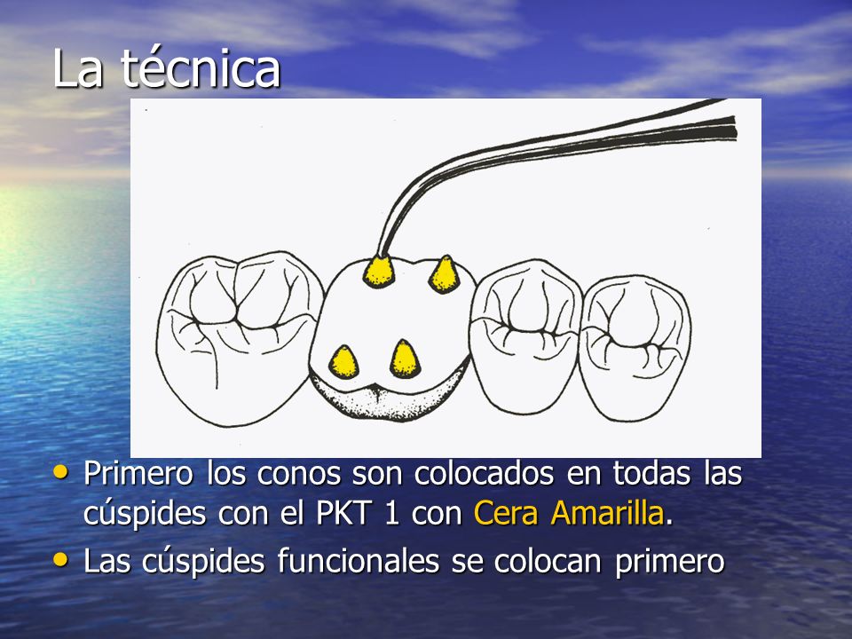 La técnica Primero los conos son colocados en todas las cúspides con el PKT 1 con Cera Amarilla.
