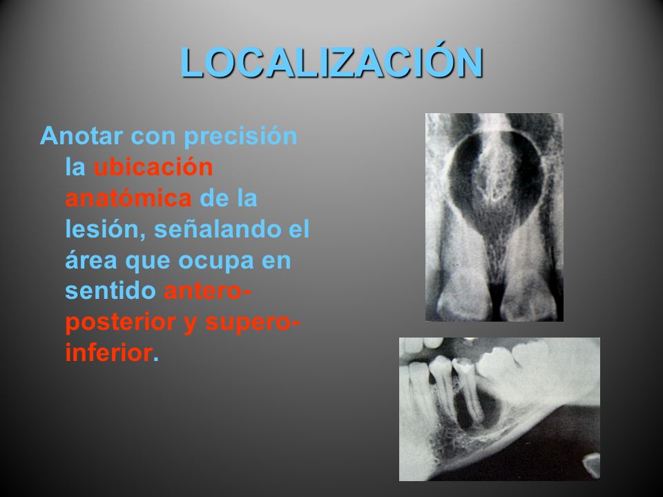 LOCALIZACIÓN Anotar con precisión la ubicación anatómica de la lesión, señalando el área que ocupa en sentido antero-posterior y supero-inferior.