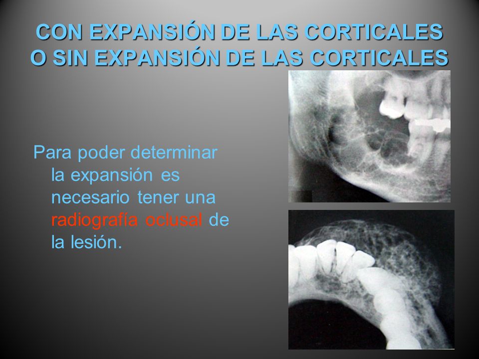 CON EXPANSIÓN DE LAS CORTICALES O SIN EXPANSIÓN DE LAS CORTICALES