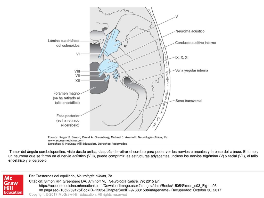 Tumor del ángulo cerebelopontino, visto desde arriba, después de retirar el cerebro para poder ver los nervios craneales y la base del cráneo. El tumor, un neuroma que se formó en el nervio acústico (VIII), puede comprimir las estructuras adyacentes, incluso los nervios trigémino (V) y facial (VII), el tallo encefálico y el cerebelo.