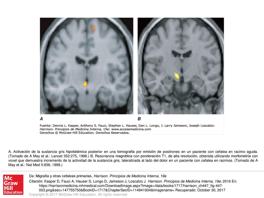 A. Activación de la sustancia gris hipotalámica posterior en una tomografía por emisión de positrones en un paciente con cefalea en racimo aguda. (Tomado de A May et al.: Lancet 352:275, 1998.) B. Resonancia magnética con ponderación T1, de alta resolución, obtenida utilizando morfometría con voxel que demuestra incremento de la actividad de la sustancia gris, lateralizada al lado del dolor en un paciente con cefalea en racimos. (Tomado de A May et al.: Nat Med 5:836, 1999.)