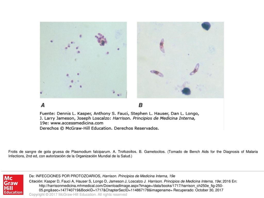 Frotis de sangre de gota gruesa de Plasmodium falciparum. A