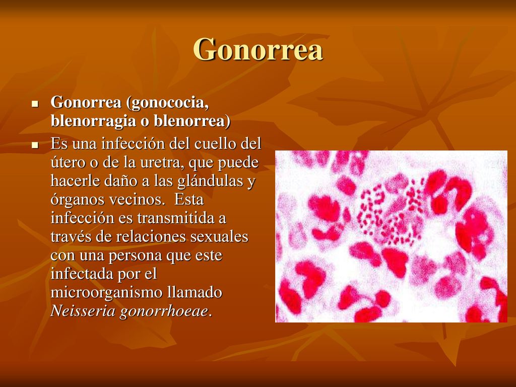Gonorrea Gonorrea (gonococia, blenorragia o blenorrea)