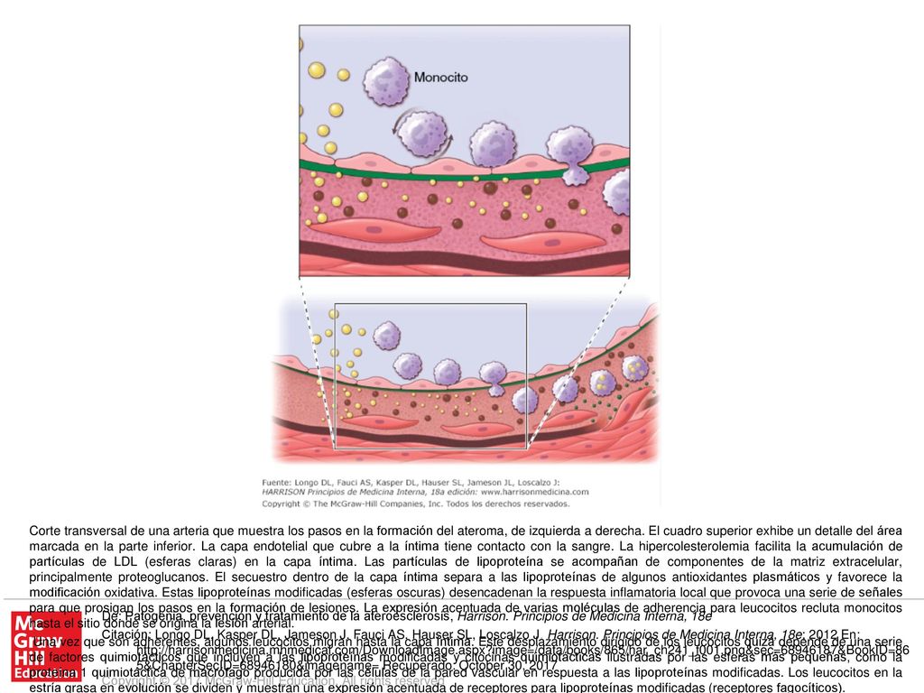 Estos mononucleares fagocitan lípidos y se convierten en células espumosas, representadas por un citoplasma lleno de gotas de lípido. Conforme la estría grasa evoluciona hasta formar una lesión ateroesclerótica más compleja, las células del músculo liso viajan desde la capa media (línea del fondo del cuadro inferior) a través de la membrana elástica interna (línea ondulada continua) y se acumulan dentro de la capa íntima en expansión, donde forman una matriz extracelular que constituye la base de la lesión avanzada (cuadro inferior, lado derecho).
