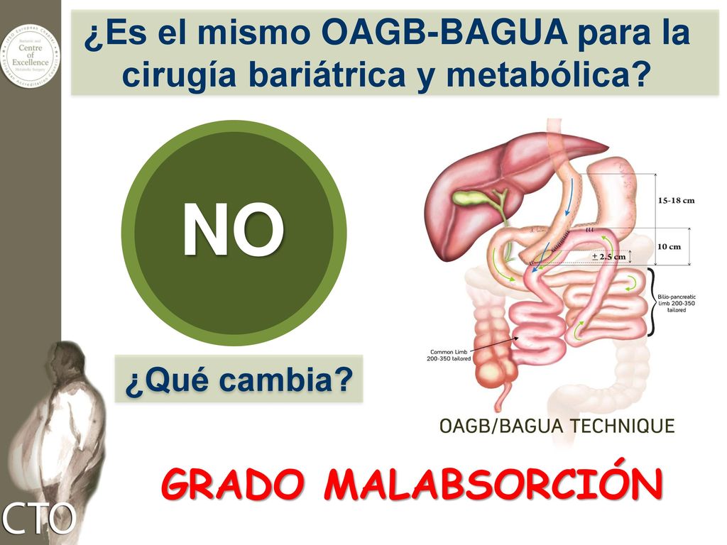¿Es el mismo OAGB-BAGUA para la cirugía bariátrica y metabólica