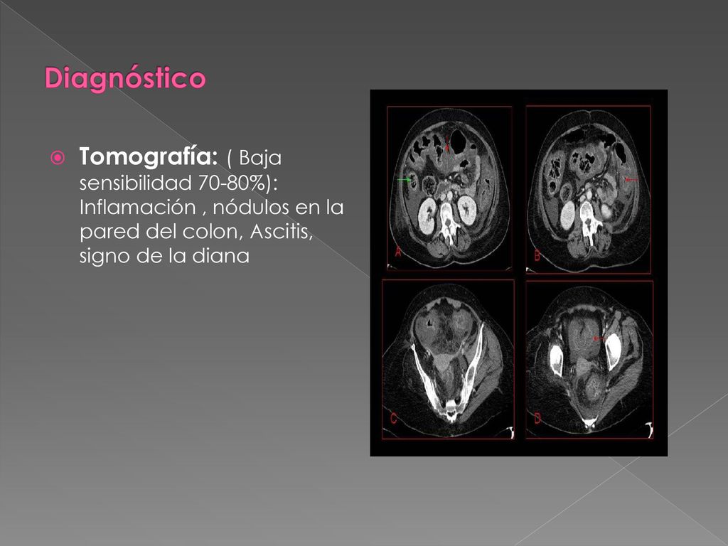 Diagnóstico Tomografía: ( Baja sensibilidad 70-80%): Inflamación , nódulos en la pared del colon, Ascitis, signo de la diana.