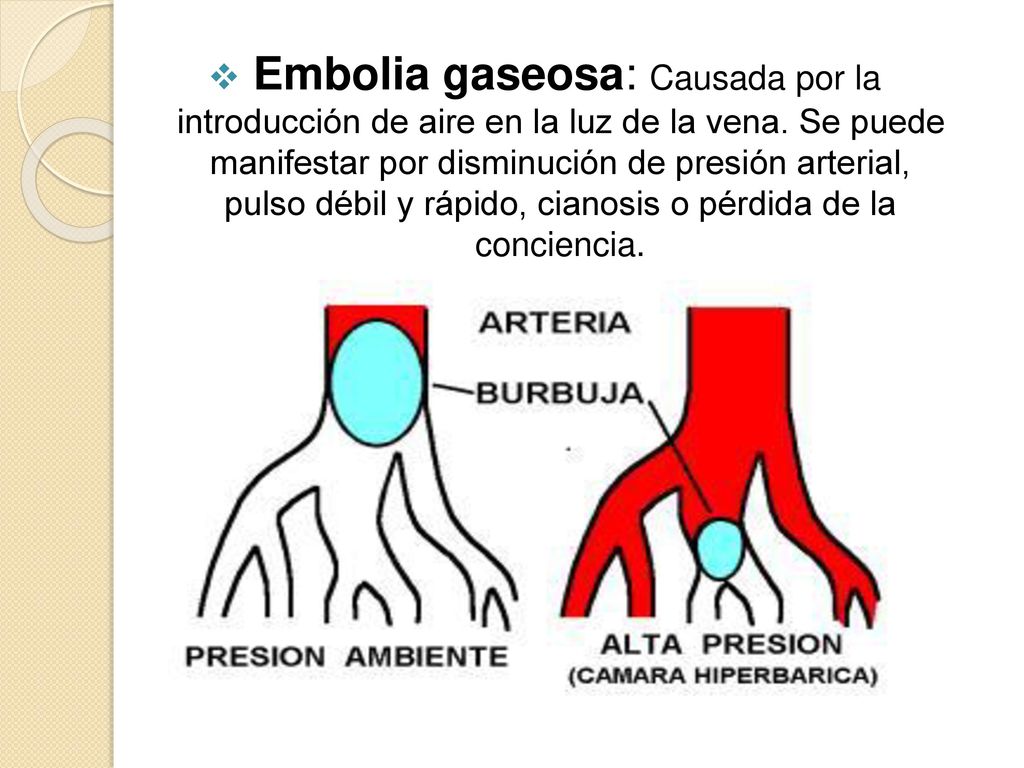 Embolia gaseosa: Causada por la introducción de aire en la luz de la vena.
